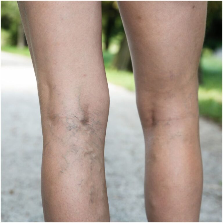 varicose-veins-spiritual-meaning-causes-symptoms-prevention