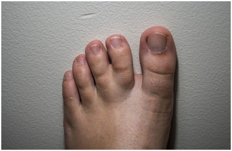 Syndactyly Webbed Toes Spiritual Meaning Causes Insight State