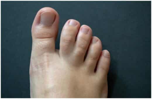 Syndactyly (Webbed Toes) - Spiritual Meaning & Causes - Insight state