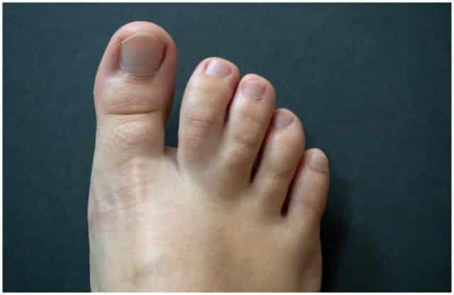 syndactyly-webbed-toes-spiritual-meaning-causes-insight-state