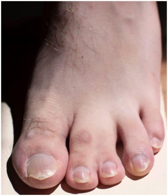 syndactyly-webbed-toes-spiritual-meaning-causes-insight-state